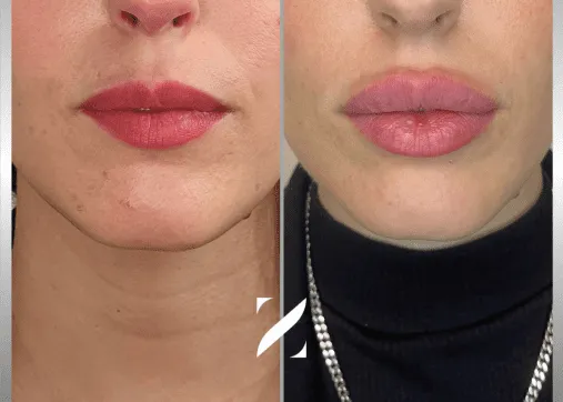 עיצוב שפתיים | עיבוי שפתיים | עיצוב ועיבוי שפתיים | ד"ר אמיר זרח – זד מדיקל קלאב