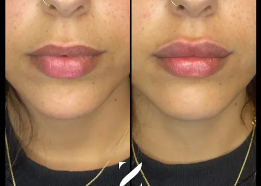 עיצוב שפתיים | עיבוי שפתיים