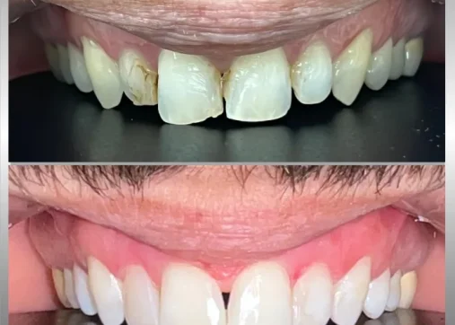 Dental veneers