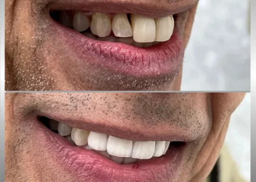 Dental veneers
