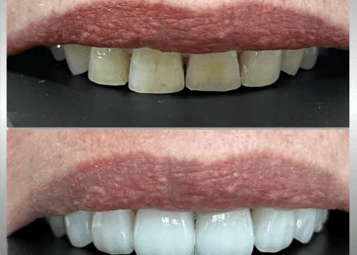 Dental veneers