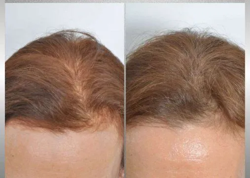 Regenera Activa שיער