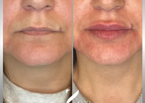 עיצוב שפתיים | עיבוי שפתיים