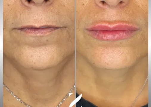 עיצוב שפתיים | עיבוי שפתיים