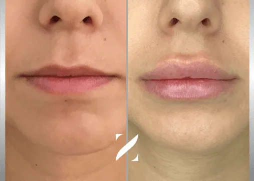 עיצוב שפתיים | עיבוי שפתיים | עיצוב ועיבוי שפתיים | ד"ר אמיר זרח – זד מדיקל קלאב