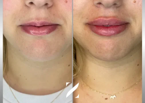 עיצוב שפתיים | עיבוי שפתיים