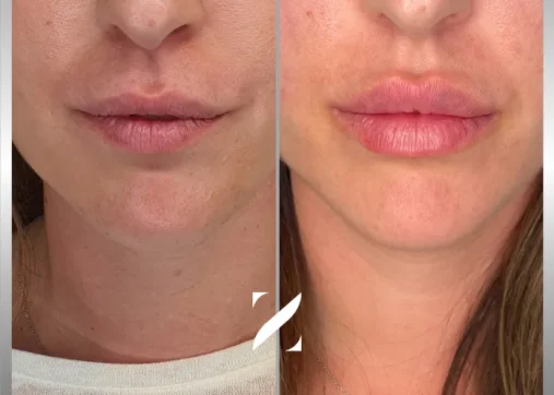 עיצוב שפתיים | עיבוי שפתיים