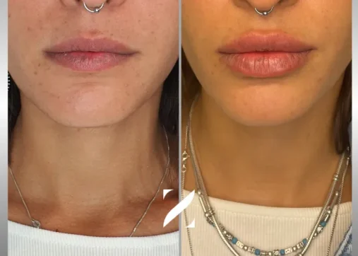 עיצוב שפתיים | עיבוי שפתיים