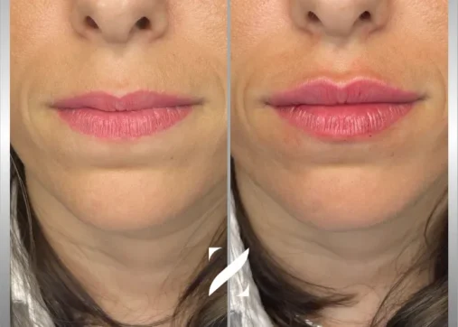 עיצוב שפתיים | עיבוי שפתיים