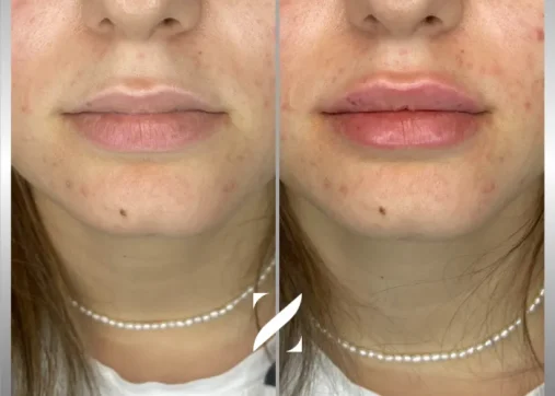 עיצוב שפתיים | עיבוי שפתיים