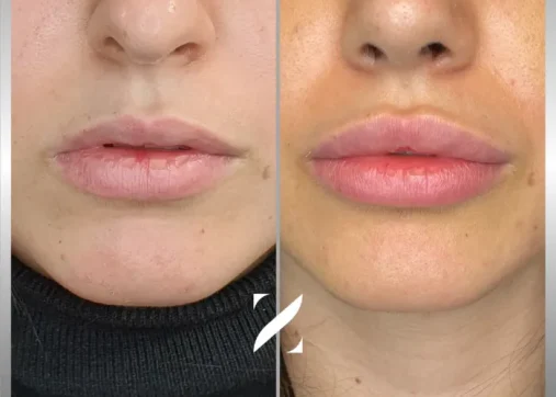 עיצוב שפתיים | עיבוי שפתיים