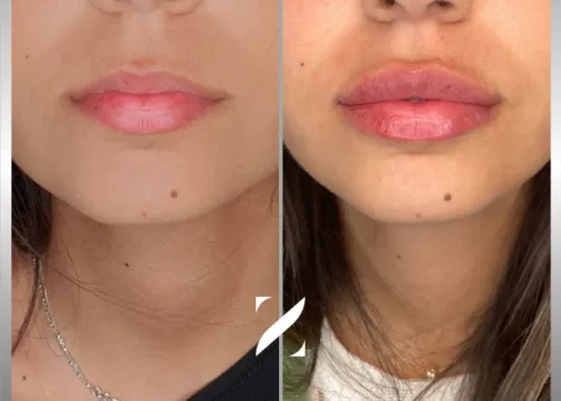 עיצוב שפתיים | עיבוי שפתיים