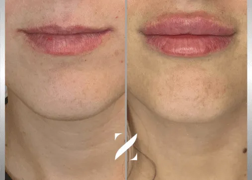 עיצוב שפתיים | עיבוי שפתיים | עיצוב ועיבוי שפתיים | ד"ר אמיר זרח – זד מדיקל קלאב