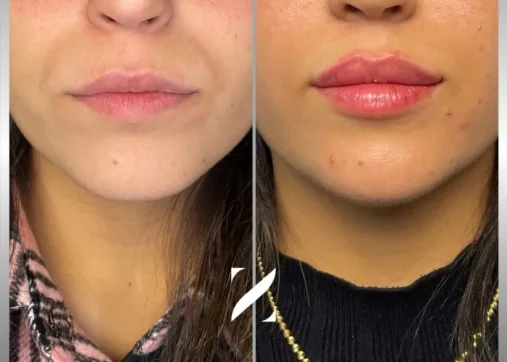 עיצוב שפתיים | עיבוי שפתיים