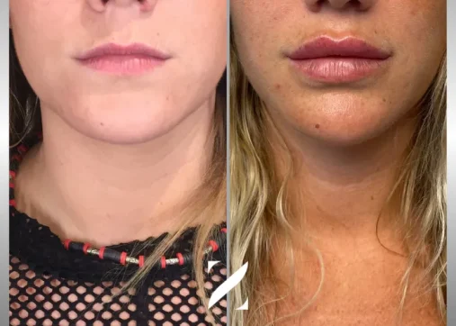 עיצוב שפתיים | עיבוי שפתיים