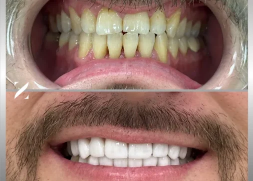 Dental veneers