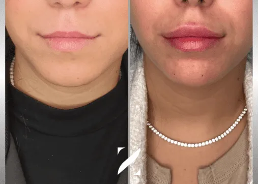 עיצוב שפתיים | עיבוי שפתיים | עיצוב ועיבוי שפתיים | ד"ר אמיר זרח – זד מדיקל קלאב