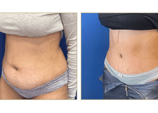 Tummy tuck and shaping