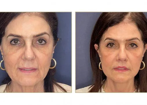 Upper or lower eyelids