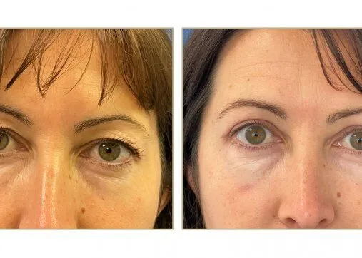 Upper or lower eyelids