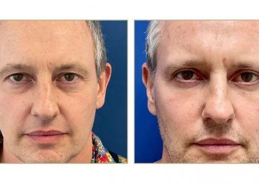 Upper or lower eyelids