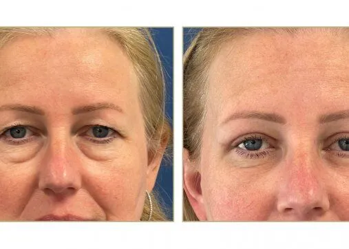 Upper or lower eyelids