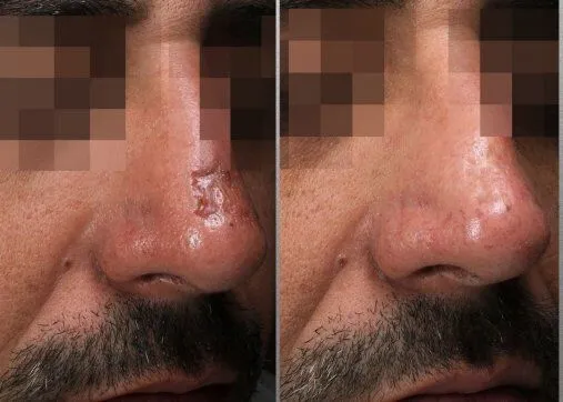 טיפול בצלקות