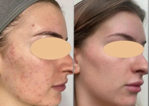 טיפול בצלקות אקנה זד מדיקל ד"ר זרח