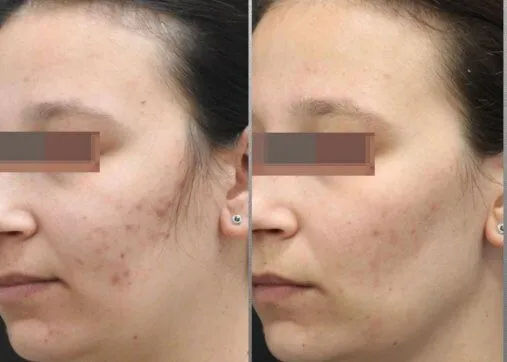 טיפול בצלקות אקנה מחלק עור זד מדיקל קלאב