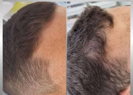 Regenera Activa שיער