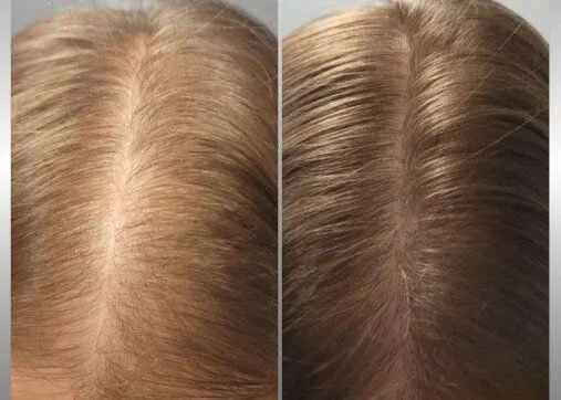 Regenera Activa שיער