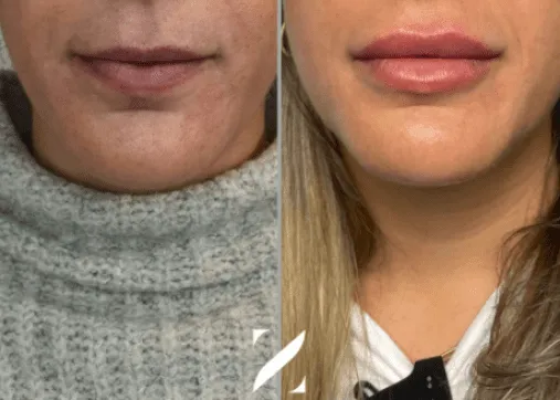 עיצוב שפתיים | עיבוי שפתיים