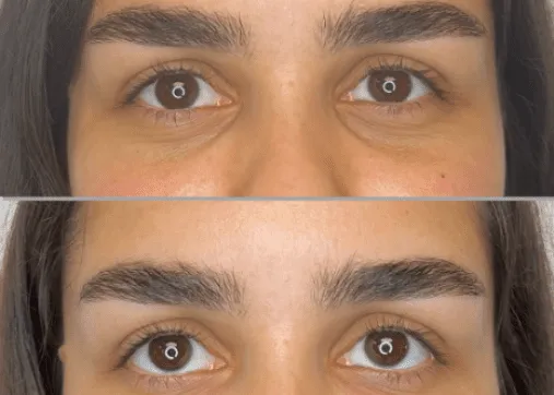 מילוי שקעי עיניים