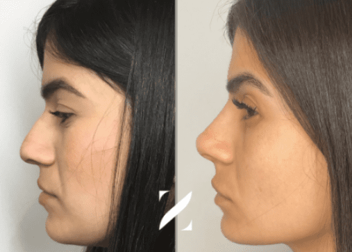 Nose shaping without surgery