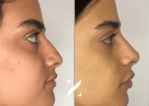 Nose shaping without surgery