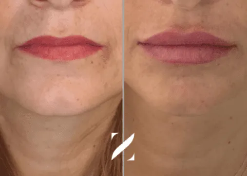 עיצוב שפתיים | עיבוי שפתיים