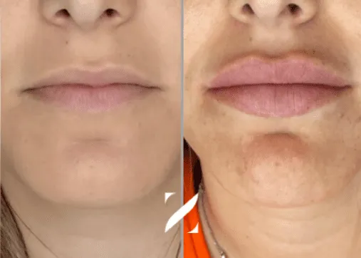 עיצוב שפתיים | עיבוי שפתיים