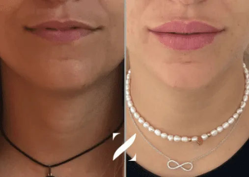 עיצוב שפתיים | עיבוי שפתיים