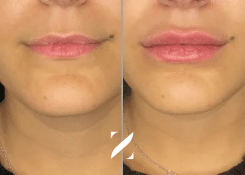 עיצוב שפתיים