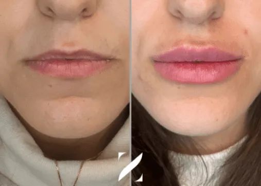 עיצוב שפתיים | עיבוי שפתיים