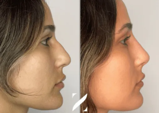 פיסול פנים ללא ניתוח - ד"ר זרח