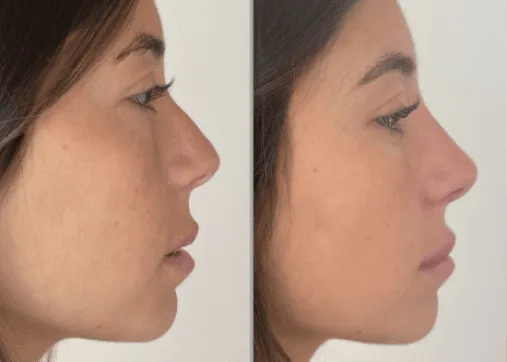 פיסול פנים ללא ניתוח - ד"ר זרח