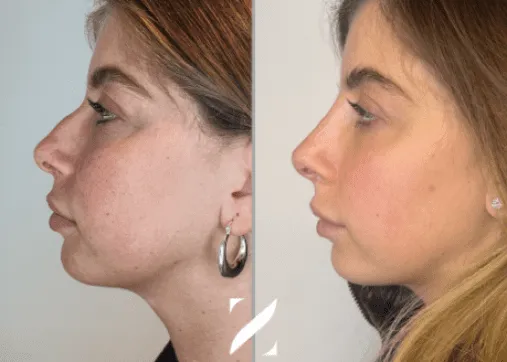 פיסול פנים ללא ניתוח - ד"ר זרח