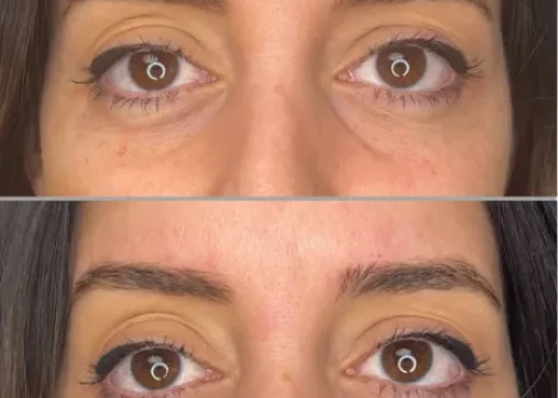 מילוי שקעי עיניים