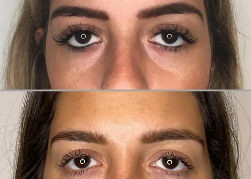 טיפולי מילוי לשקעי העיניים