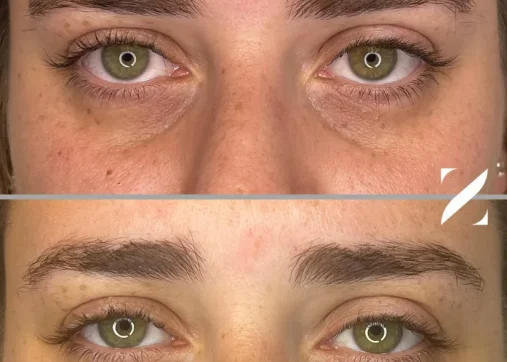 מילוי שקעי עיניים