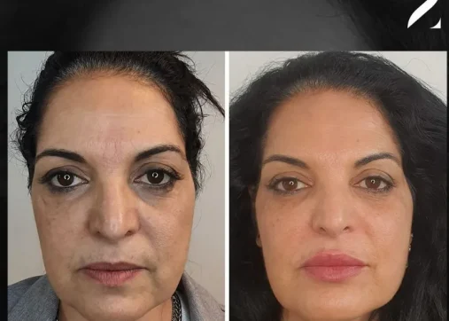 פיסול פנים ללא ניתוח