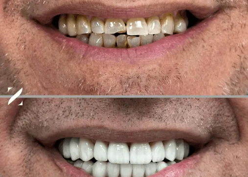 Dental veneers