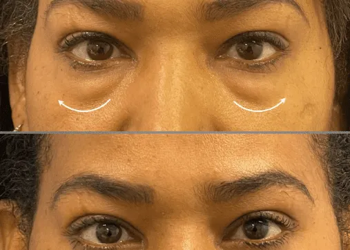Lower eyelids - fat and excess skin