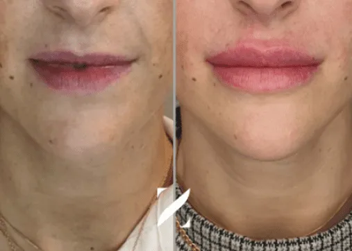 עיצוב שפתיים | עיבוי שפתיים | עיצוב ועיבוי שפתיים | ד"ר אמיר זרח – זד מדיקל קלאב